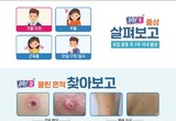 SFTS 환자 잇따라 발생…진드기 주의